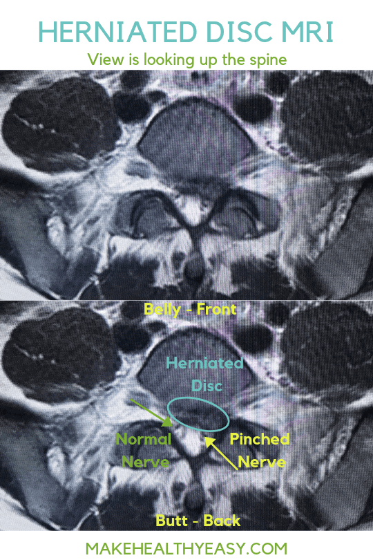 are pinched nerves same as bad vertebra in dogs